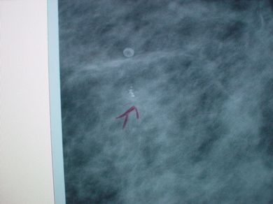 031008_mammography.jpg