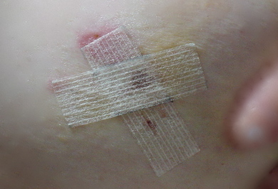 061108_mammotome.jpg