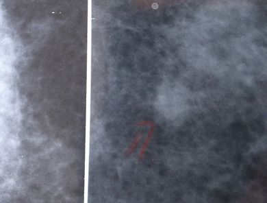 080610_mammogram.jpg